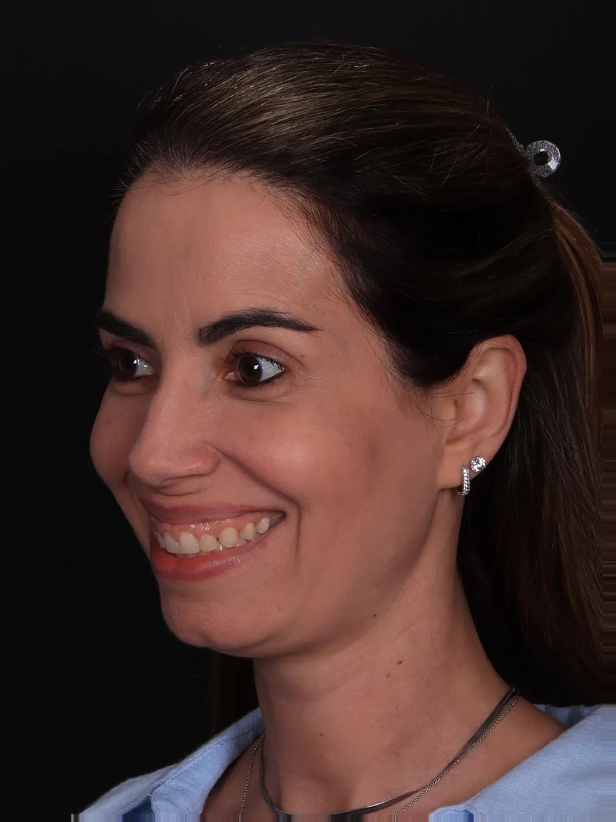 Antes: prótese subnasal associada a mentoplastia