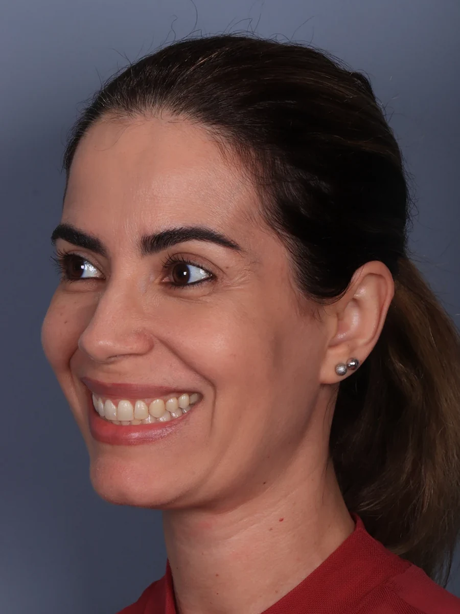 Depois: prótese subnasal associada a mentoplastia