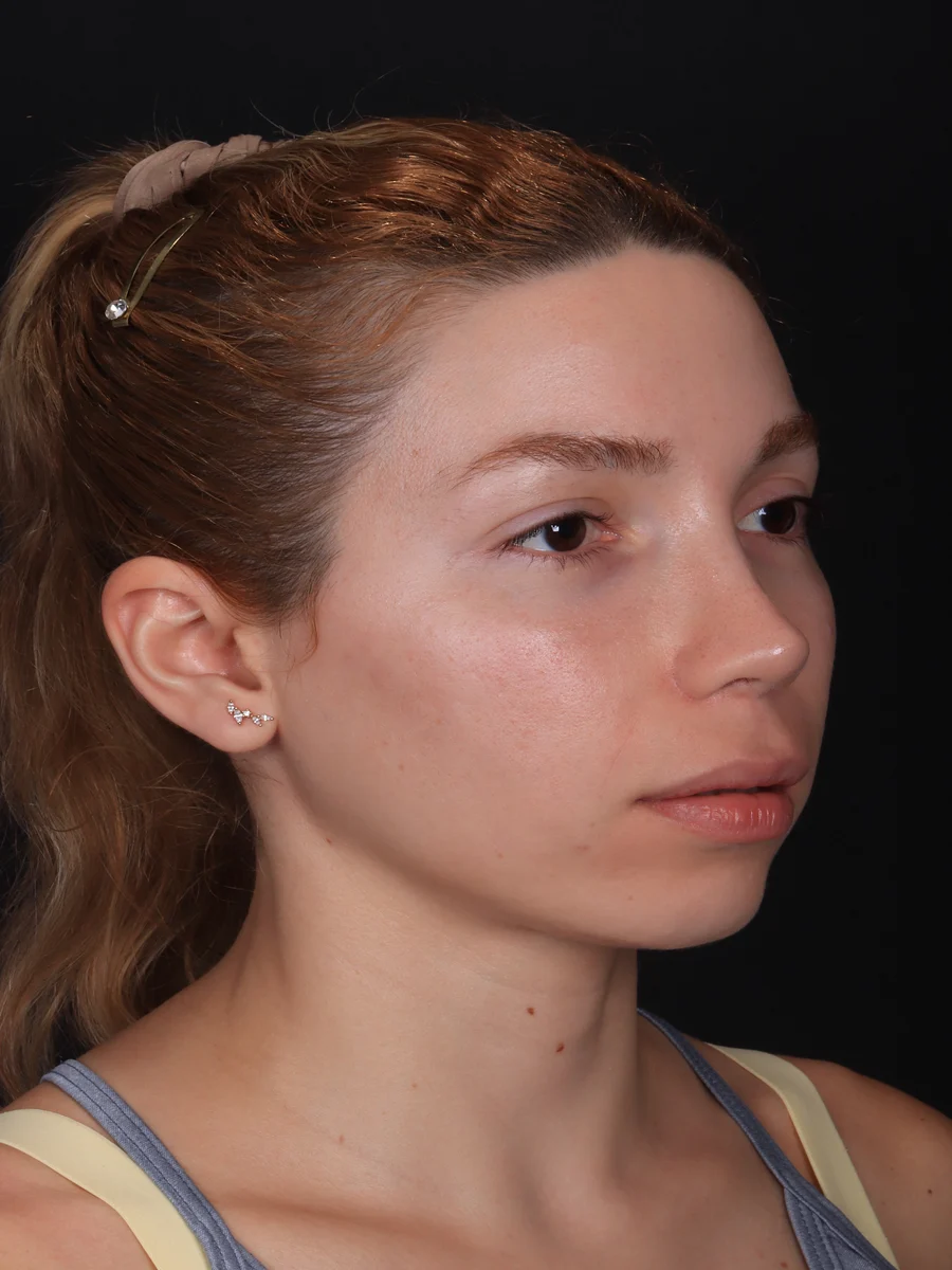 Antes: mentoplastia associada a lip lift e lifting do terço médio