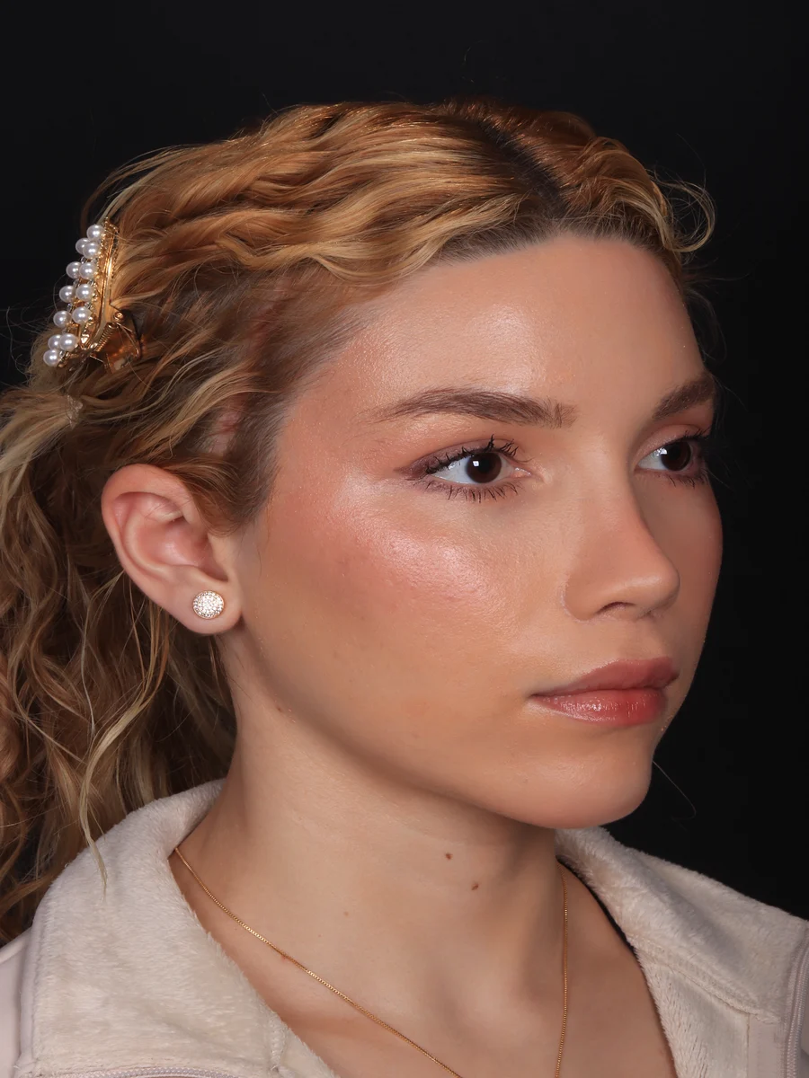 Depois: mentoplastia associada a lip lift e lifting do terço médio